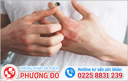 Tiêm penicillin giang mai ở thời điểm nào tốt nhất?