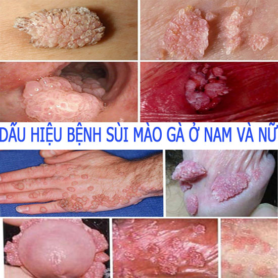 Dấu hiệu sùi mào gà sau khi quan hệ 1 lần ở nam và nữ giới