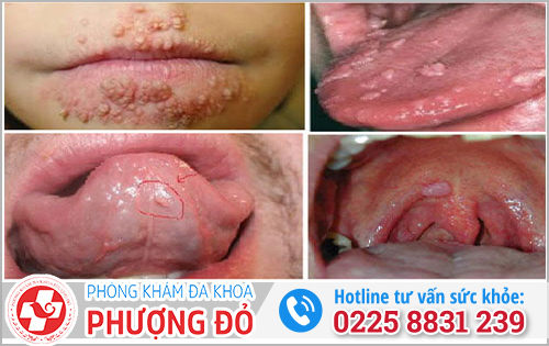 Dấu hiệu mắc sùi mào gà ở miệng
