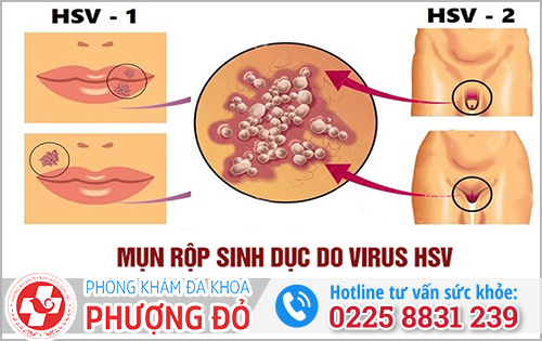 Tổng quan về bệnh mụn rộp sinh dục