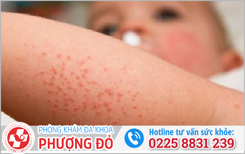 Biến chứng mụn rộp sinh dục 
