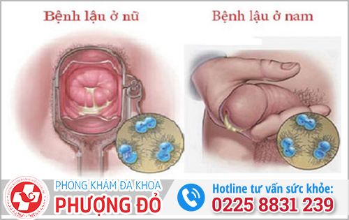 Dấu hiệu phát triển bệnh Lậu sau thời gian ủ bệnh