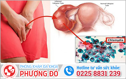 Thời gian ủ bệnh Chlamydia