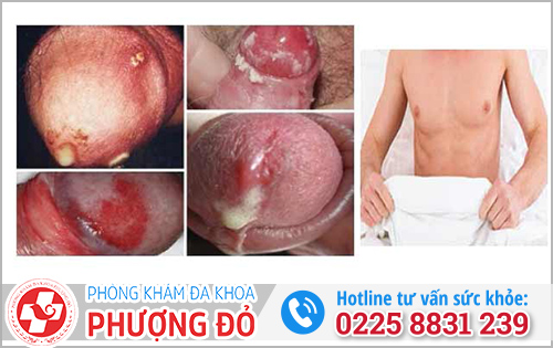 Nam mắc bệnh lậu có triệu chứng gì?