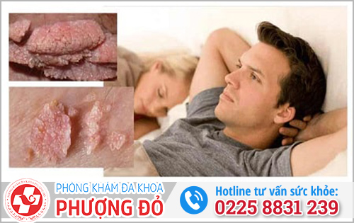 Tại sao vợ bị sùi mào gà mà chồng không bị?