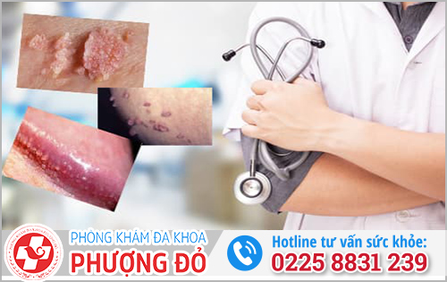 Điều trị sùi mào gà