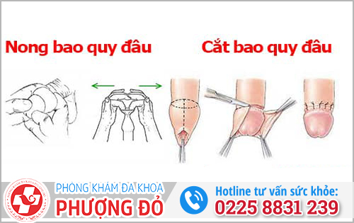 13 tuổi chưa lột bao quy đầu phải làm sao?