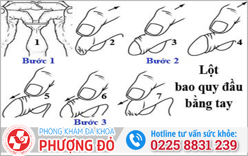 Cách tự lột bao quy đầu 