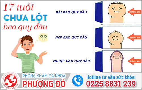 17 tuổi chưa lột bao quy đầu 