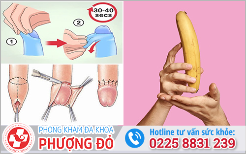 17 tuổi mà chưa lột bao quy đầu thì nên làm gì?