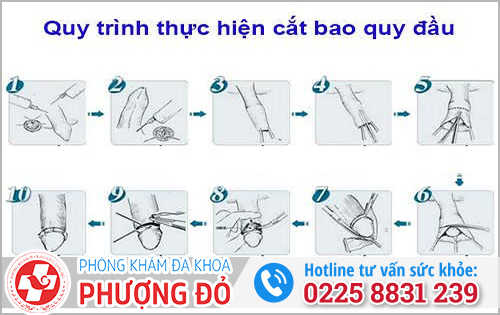 Quy trình cắt bao quy đầu hiện nay
