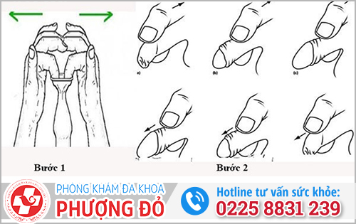 Cách lột bao quy đầu dài 