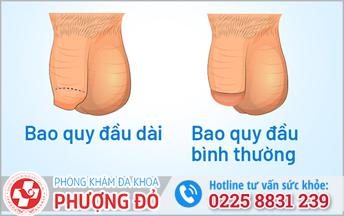 Bao quy đầu dài có sao không?