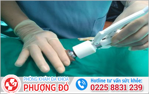 Điều trị bao quy đầu nhạy cảm