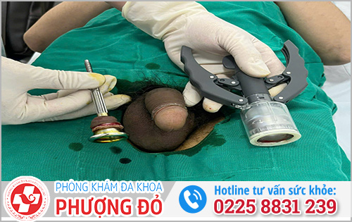 Hình ảnh bệnh nhân cắt bao quy đầu đại bệnh viện uy tín