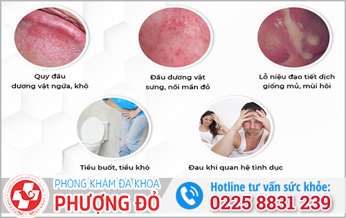 Bệnh nấm dương vật