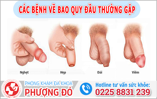 Các bệnh về bao quy đầu phổ biến hiện nay