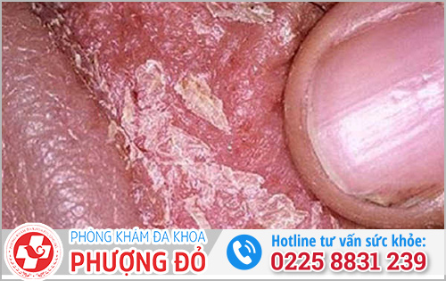 Bao quy đầu bị khô, tróc da, nứt nẻ