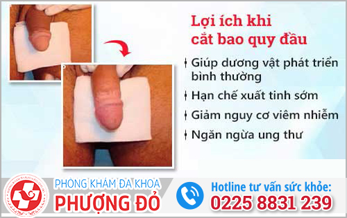 Lý do chọn đúng phương pháp cắt bao quy đầu