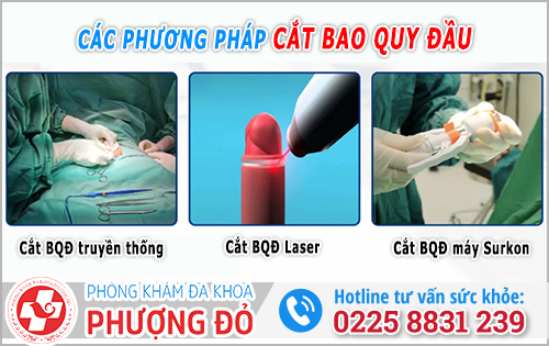 Những phương pháp cắt bao quy đầu