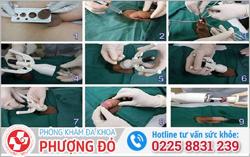 Kỹ thuật cắt bao quy đầu xâm lấn tối thiểu