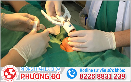 Cắt bao quy đầu bằng máy Stapler