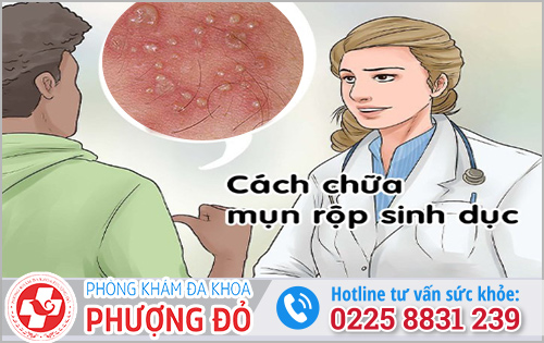 Cách điều trị mụn rộp sinh dục