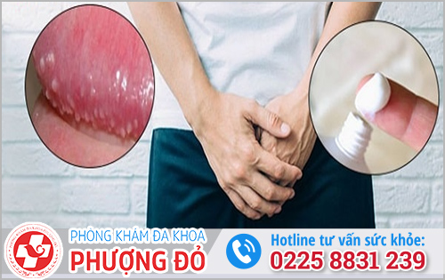 Chữa hạt ngọc sinh dục tại nhà bằng thuốc