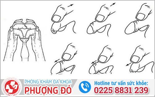 Cách nong dính bao quy đầu