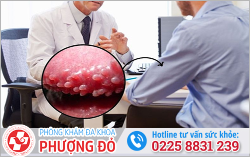 Cách trị hạt ngọc dương vật