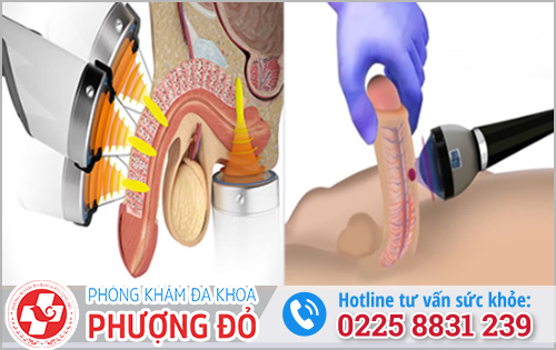 Điều trị rối loạn cương dương bằng liệu pháp sóng âm