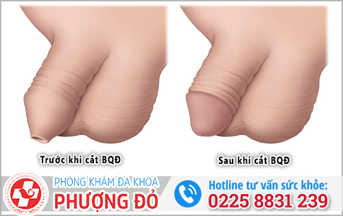 Sau khi cắt bao quy đầu có được cương không?