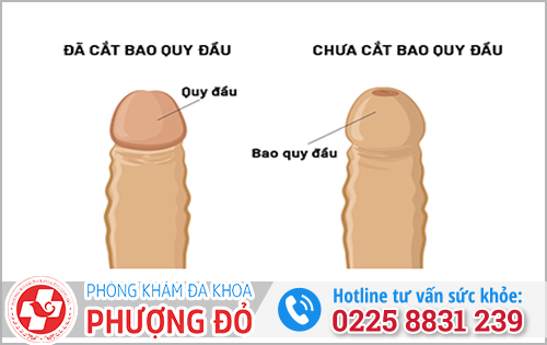 Cách nhận biết đã cắt bao quy đầu