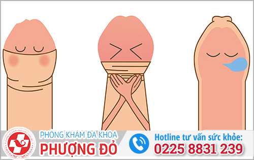 Nếu không chắc đã cắt bao quy đầu chưa thì nên làm gì?