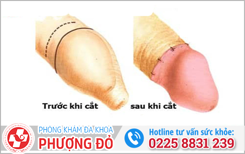 Trị nấm dương vật