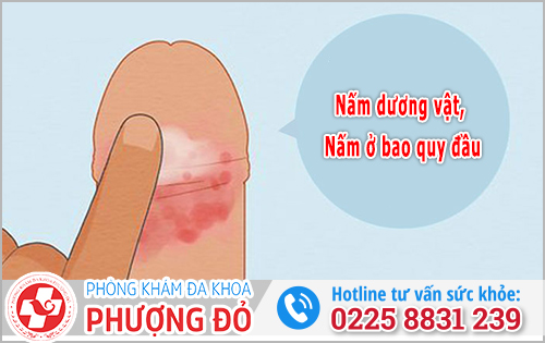 Nấm vùng kín ở nam giới là gì?