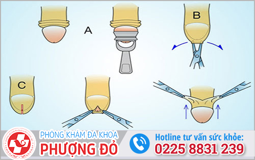 Phương pháp lột bao quy đầu hiện nay