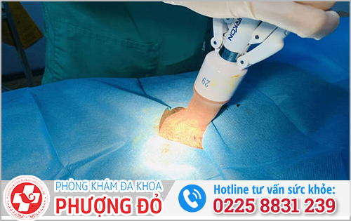Cắt bao quy đầu là gì?