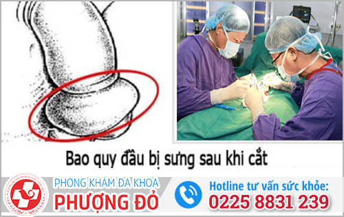 Cắt bao quy đầu xong bị sưng