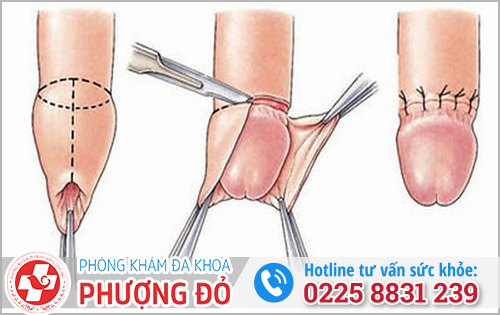 Cách xử lý dương vật nổi mụn trắng ngứa 