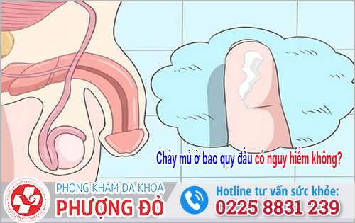 Chảy mủ ở bao quy đầu có nguy hiểm không?