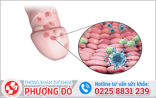 Chảy mủ bao quy đầu có thể là bệnh herpes sinh dục