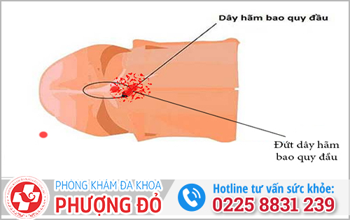 Vì sao nam giới phải nối dây hãm bao quy đầu?