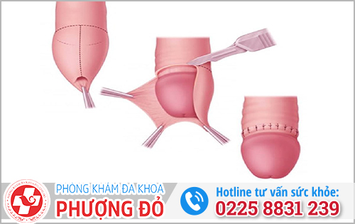 Cắt bao quy đầu là gì? 