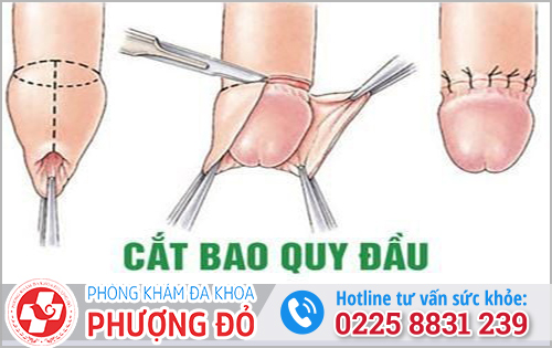 Dài bao quy đầu thì xử lý bằng cách nào?