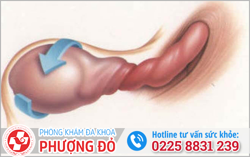 Xoắn tinh hoàn khiến nam giới bị đau tinh hoàn tiểu buốt