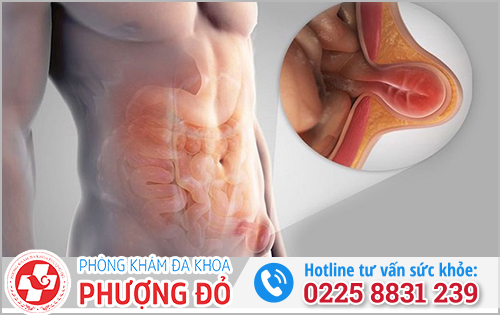 Đau tinh hoàn trái lan xuống bụng dưới là do bệnh thoát vị bẹn