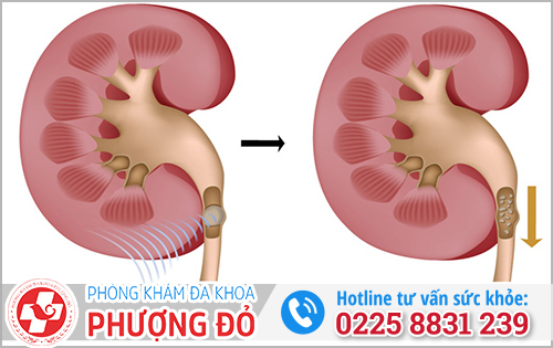 Nguyên nhân đi tiểu bị đau bụng dưới