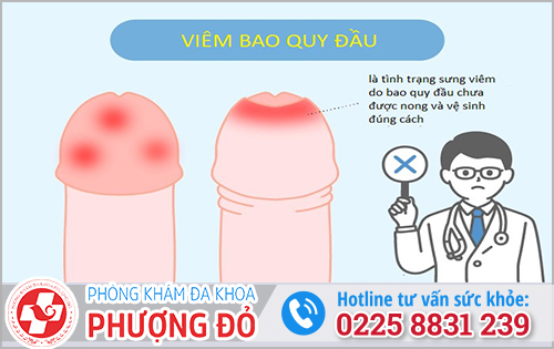 Viêm bao quy đầu