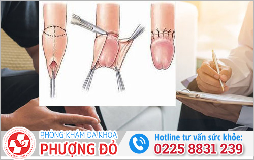 Cắt bao quy đầu ngoài giờ 